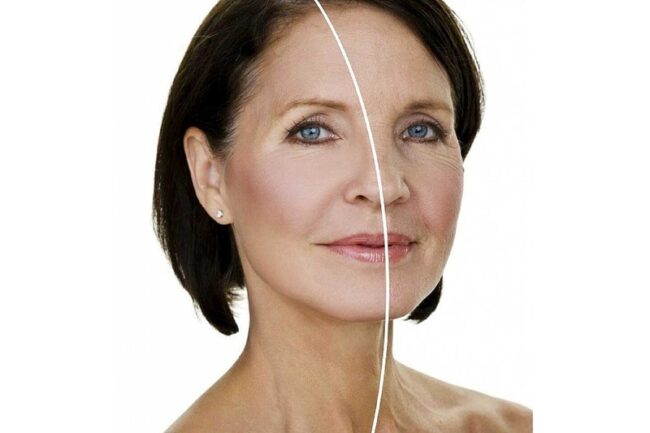 Ameliyatsız Yüz Germe