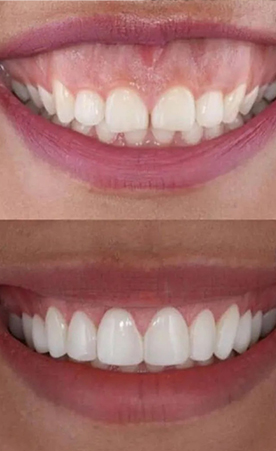 Gummy Smile Diş Eti Estetiği