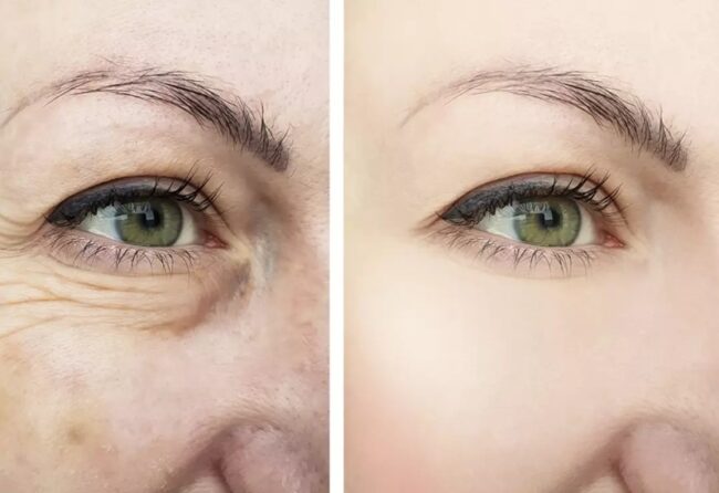 Kırışıklıkları Düzeltme