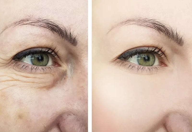 Kırışıklıkları Düzeltme