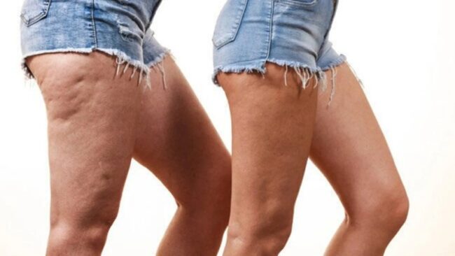 Selülit Tedavisi Selülit Tedavisi